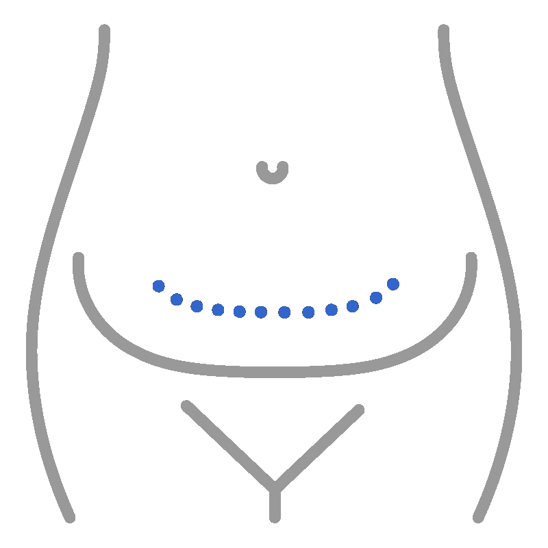 Abdominoplastia