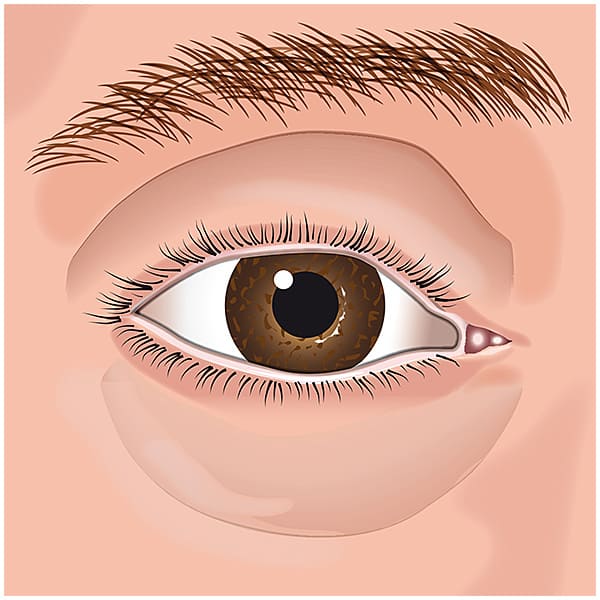 Cirurgia plástica estética nas pálpebras