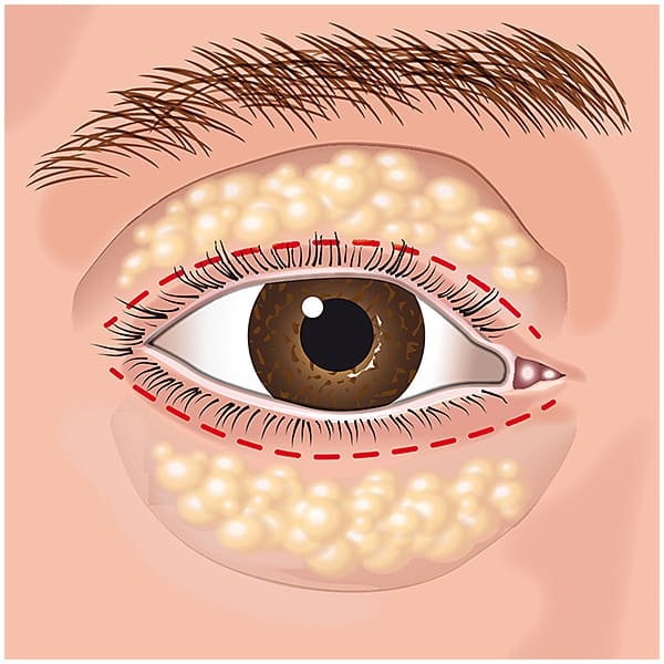 Cirurgia plástica estética nas pálpebras