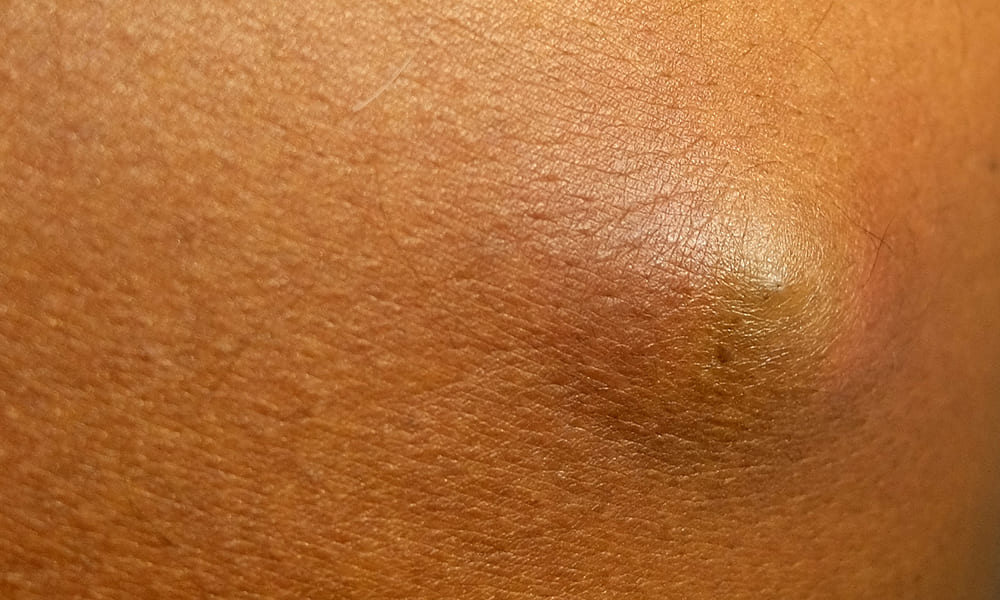 Lipoma