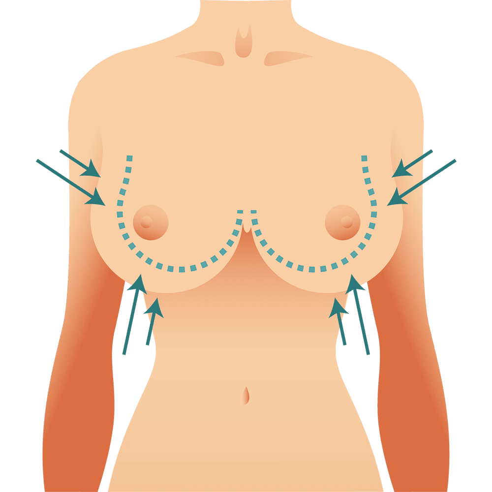 Mamoplastia Redutora