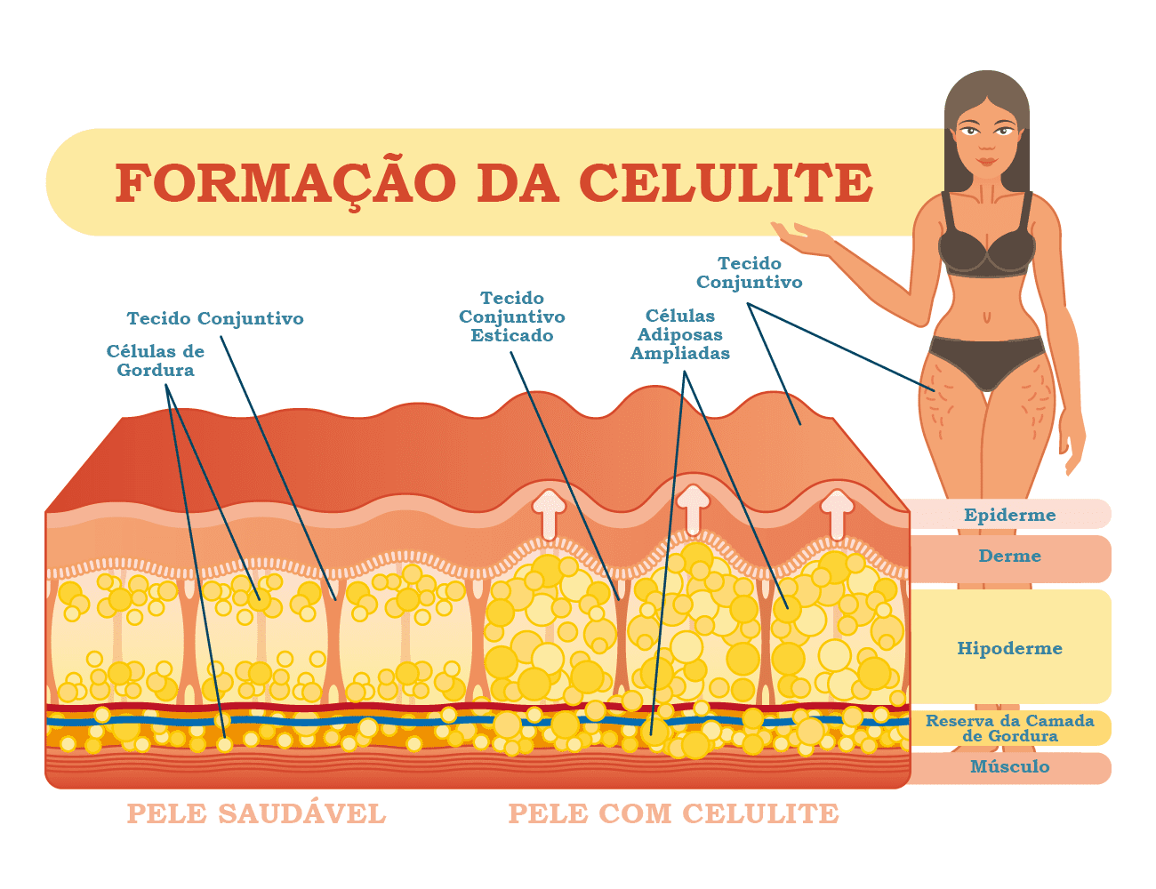 Formação da celulite