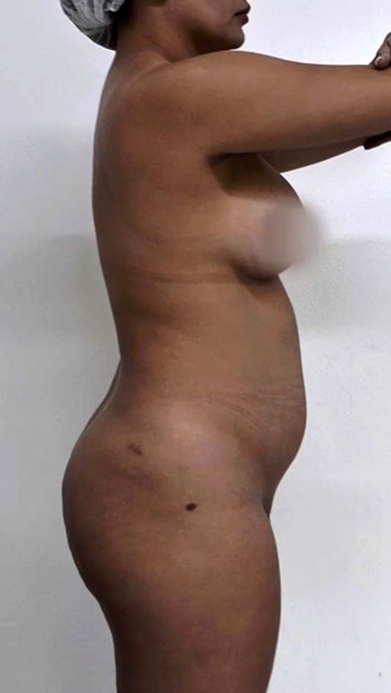 Lipominiabdominoplastia + redução de dobras nas costas + contorno do bumbum